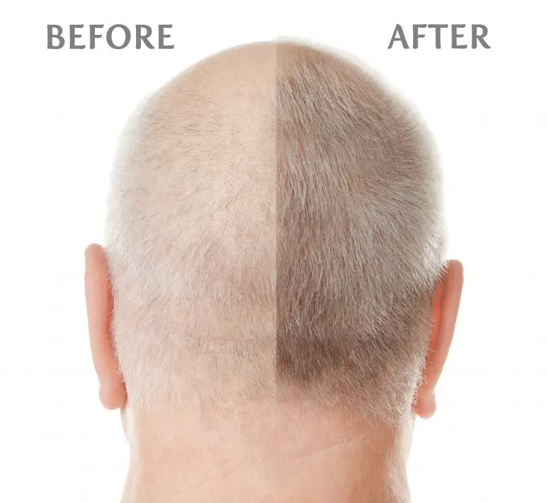 Folexin Results: Before And After